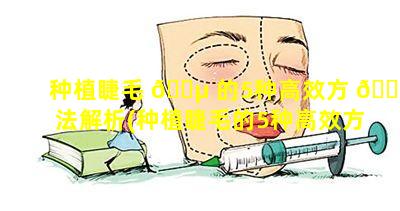 种植睫毛 🌵 的5种高效方 🐅 法解析(种植睫毛的5种高效方法解析图片)